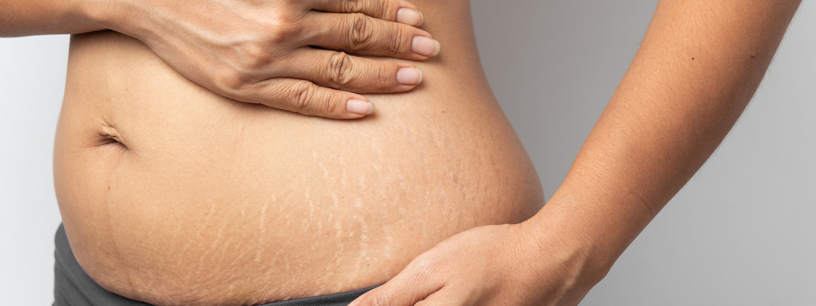 Inkless Stretch Mark & Ink Stretch Mark