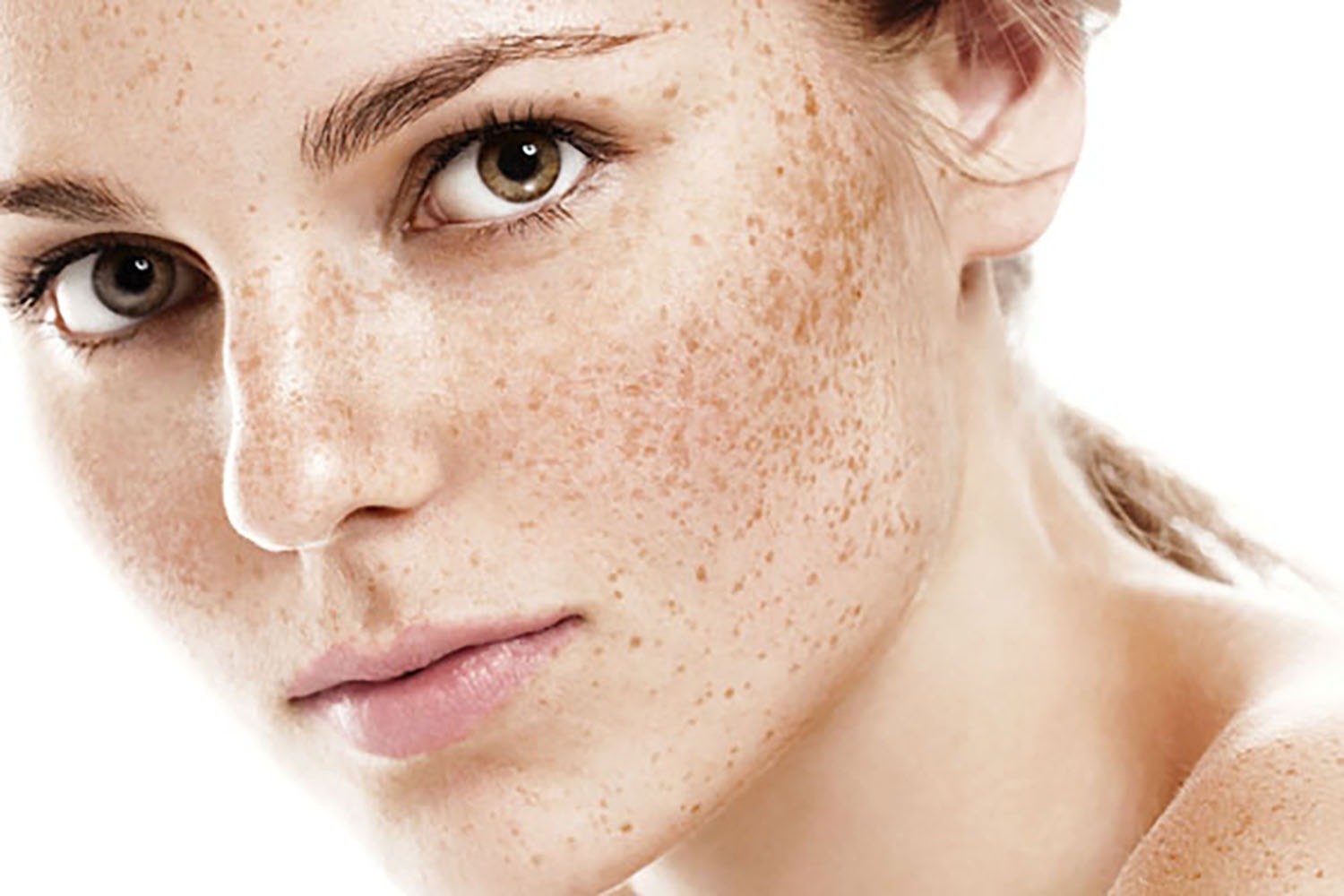 permanent freckles