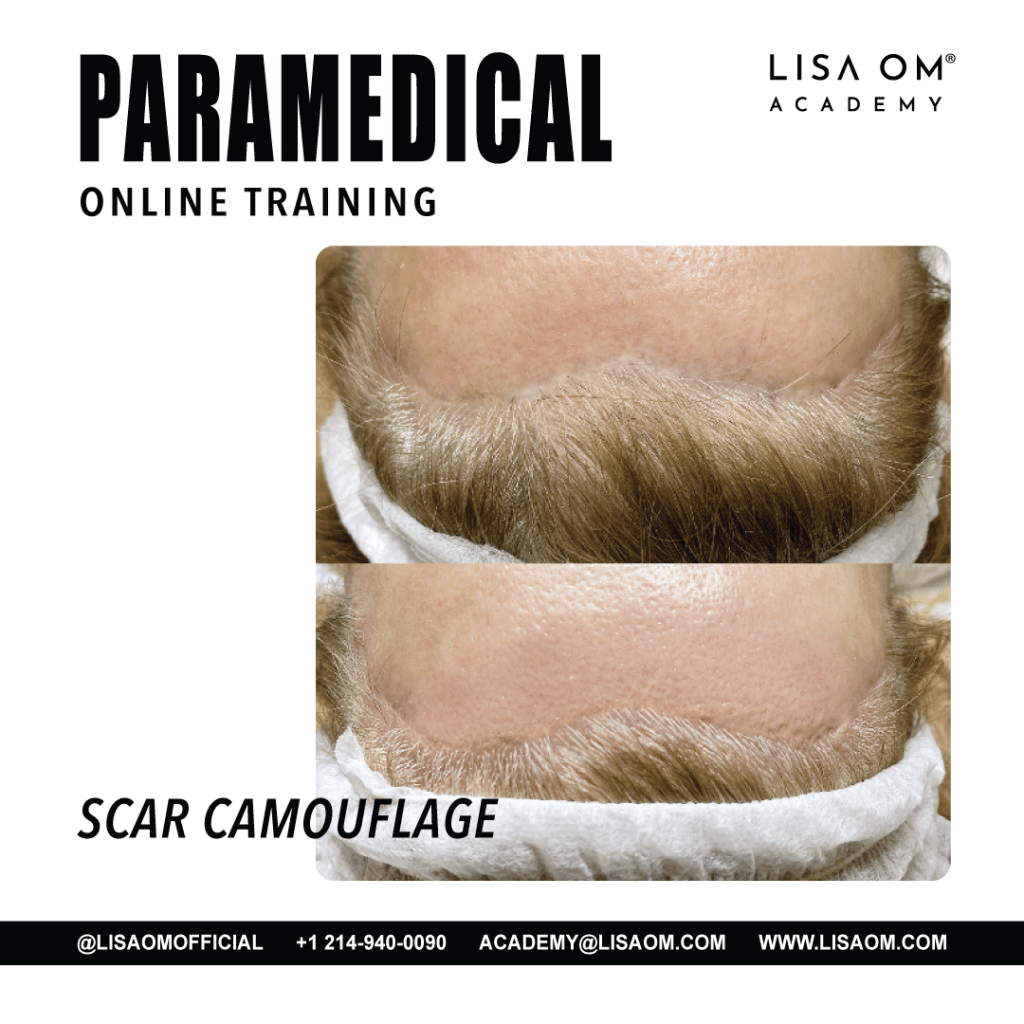 Online Scar Camouflage Training Course